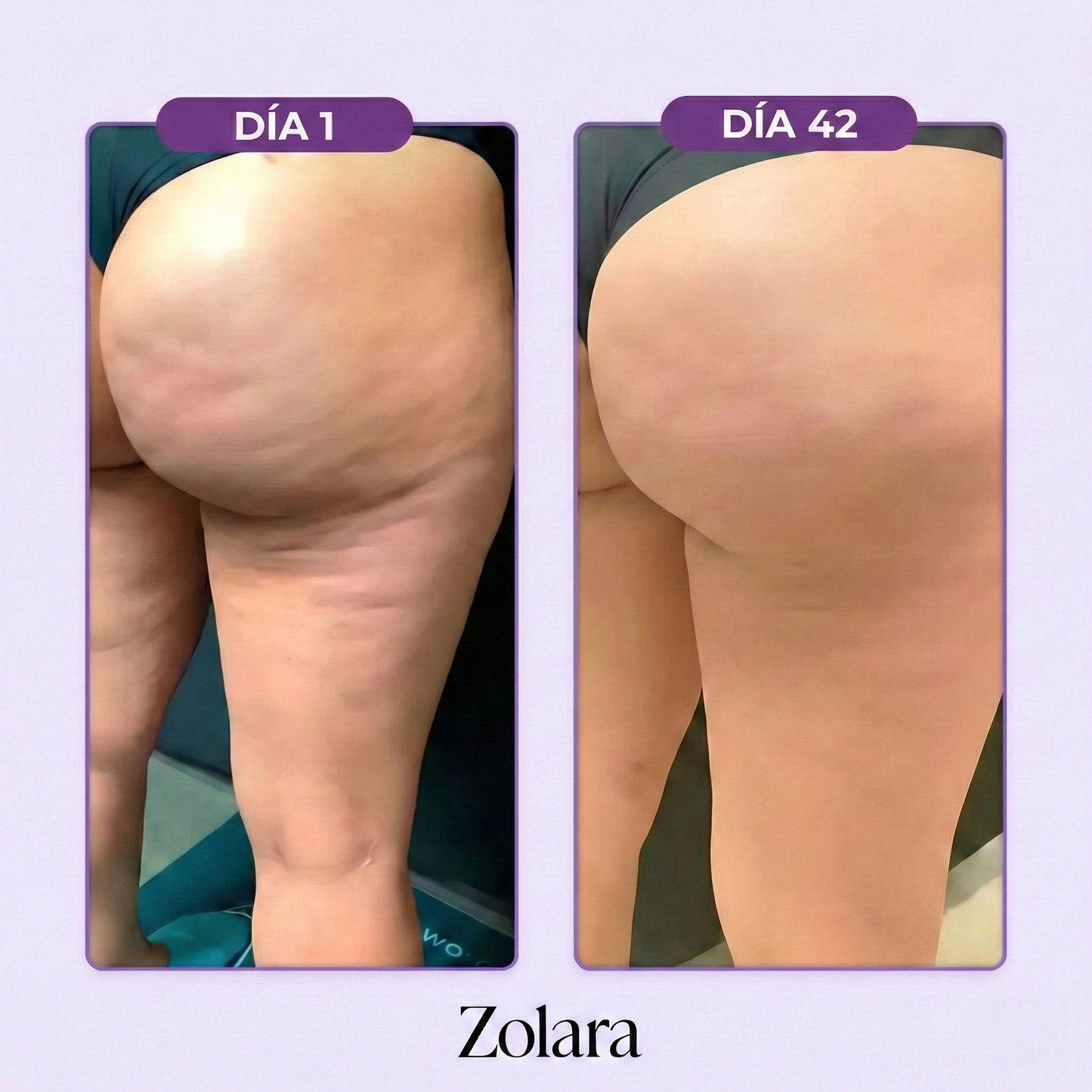 Sistema 4-en-1 Anti-Celulitis